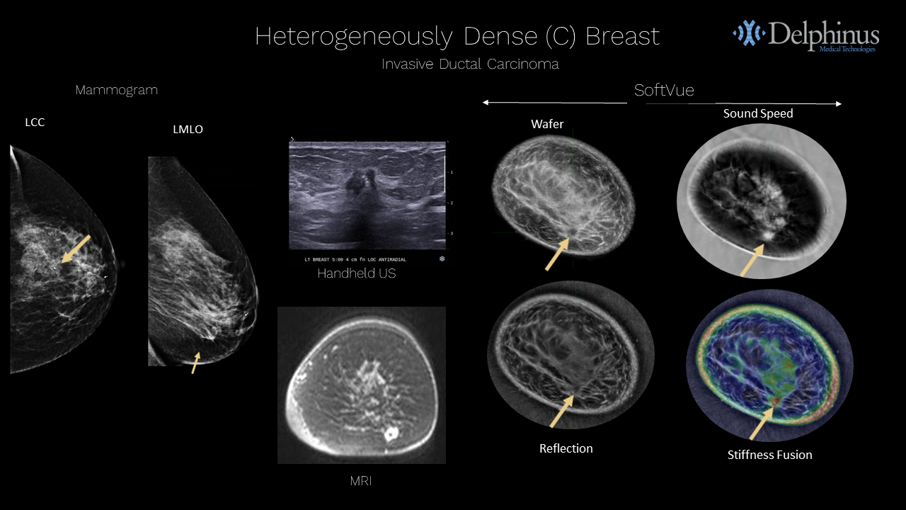 Delphinus Medical Announces Installation of SoftVue Breast Imaging System at UR Medicine