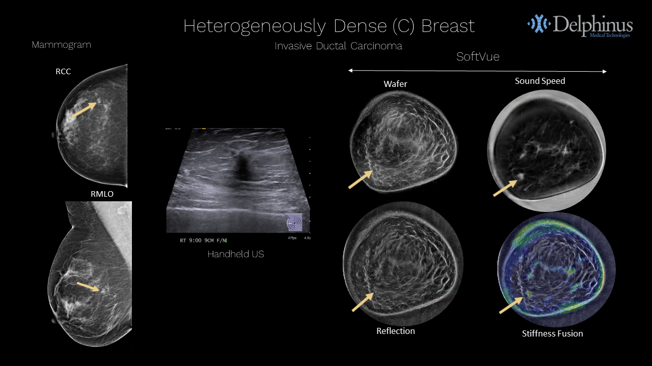 Delphinus Medical Announces Installation of SoftVue Breast Imaging System at UR Medicine