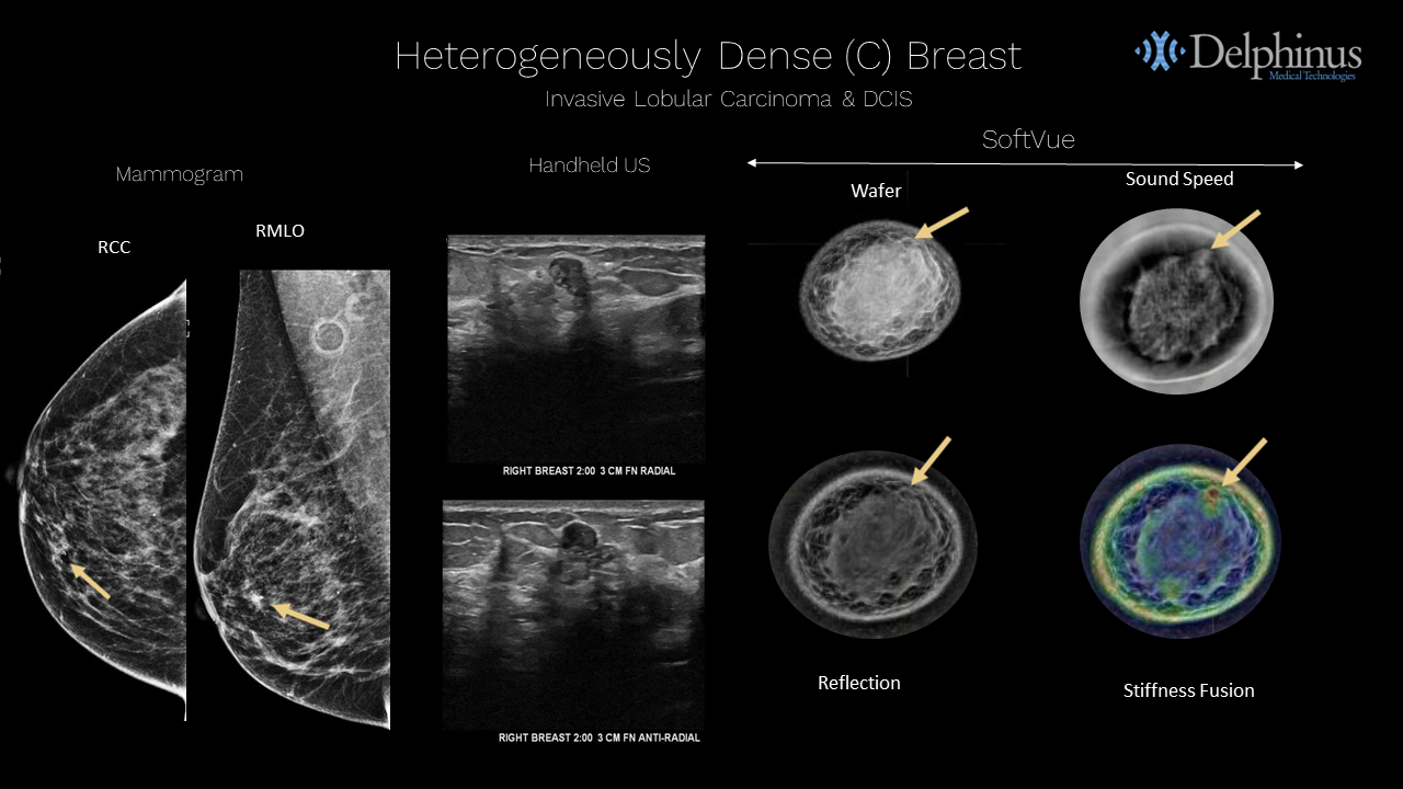 Delphinus Medical Announces Installation of SoftVue Breast Imaging System at UR Medicine