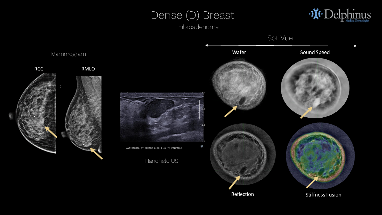 Delphinus Medical Announces Installation of SoftVue Breast Imaging System at UR Medicine