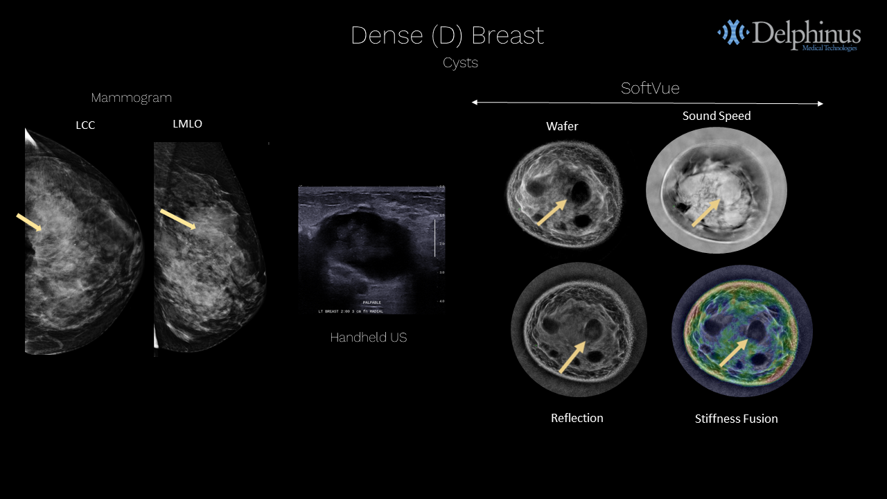 Delphinus Medical Announces Installation of SoftVue Breast Imaging System at UR Medicine