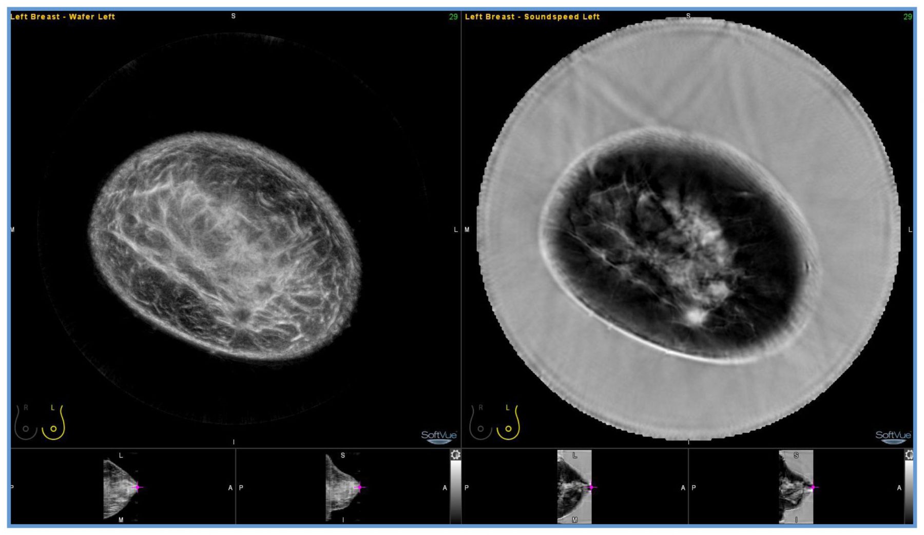 Delphinus Medical Announces Installation of SoftVue Breast Imaging System at UR Medicine