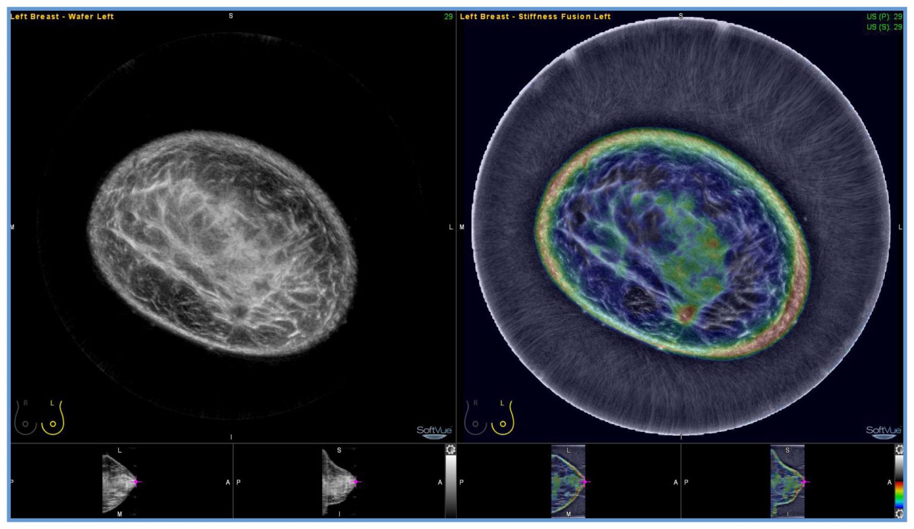 Delphinus Medical Announces Installation of SoftVue Breast Imaging System at UR Medicine