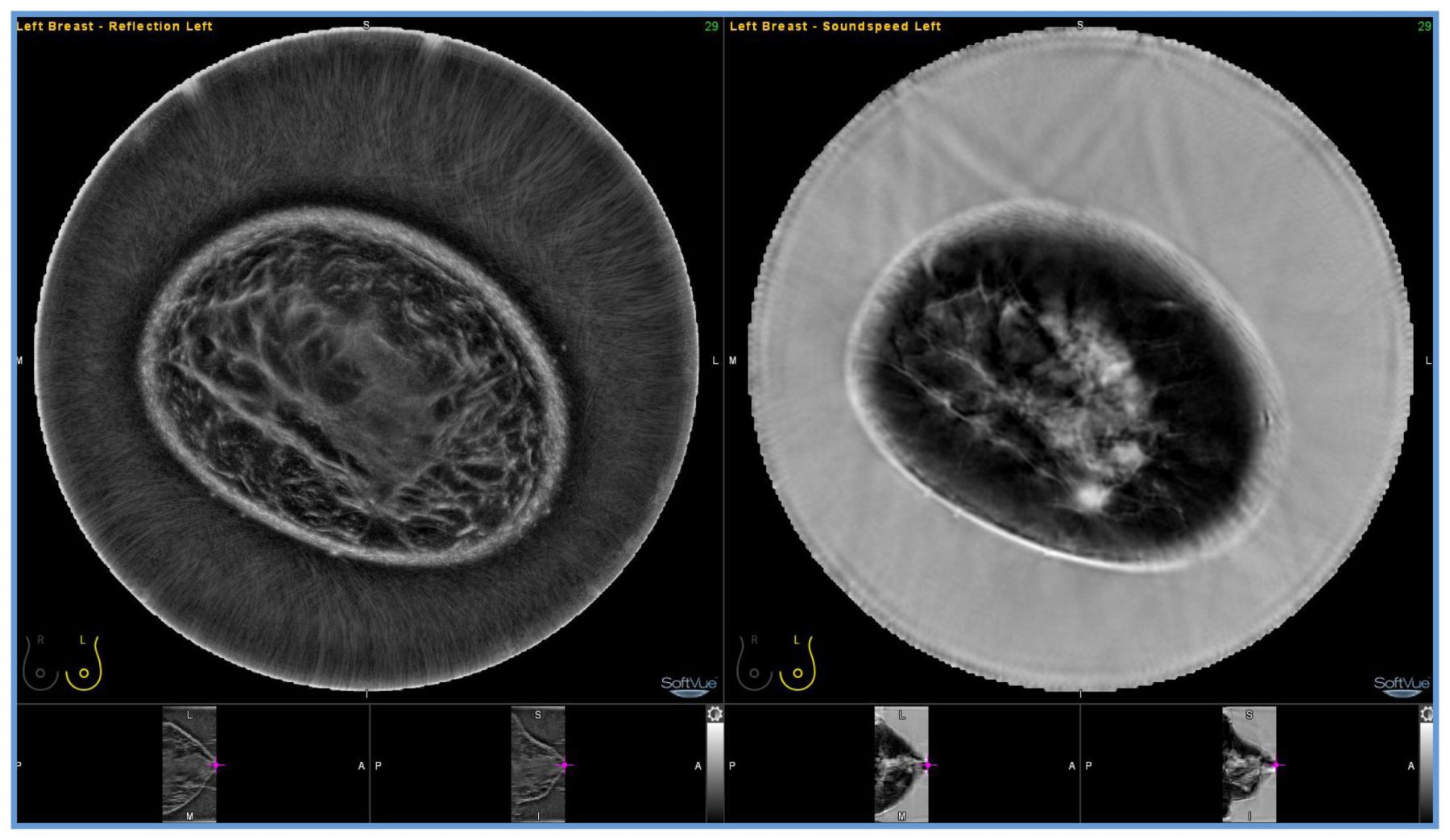 Delphinus Medical Announces Installation of SoftVue Breast Imaging System at UR Medicine